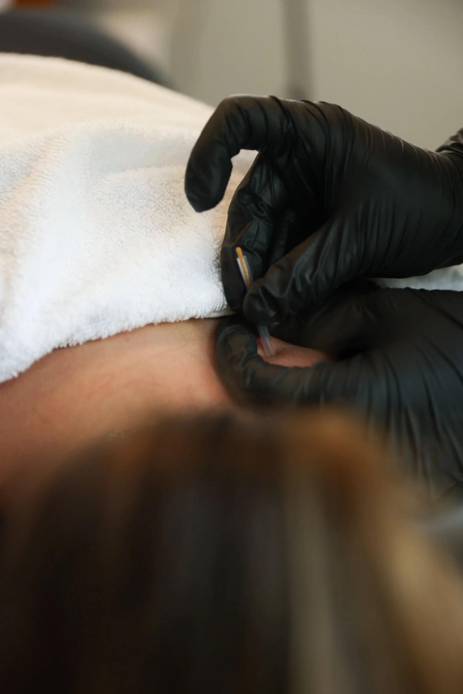 dry needling in charlotte