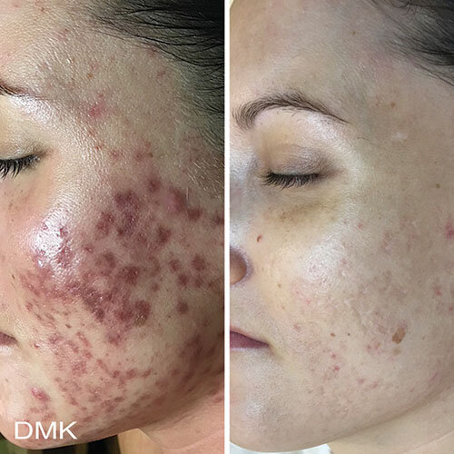 DMK-Scaring-Treatment.jpg