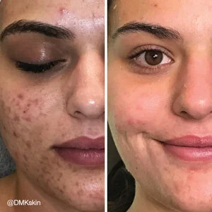 Acne DMK Treatment - Before and After