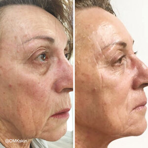 Anti Ageing DMK Treatment - Before and After