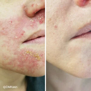 Reactive Skin DMK Treatment - Before and After