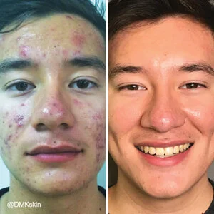 Acne Scaring DMK Treatment - Before and After
