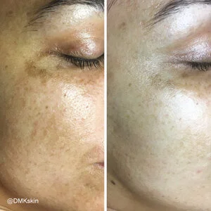 Pigmentation DMK Treatment - Before and After