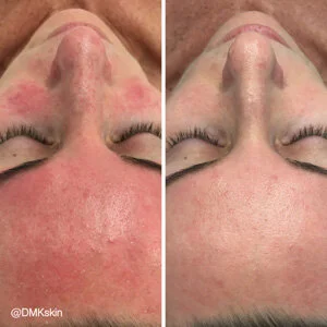 Reactive Skin DMK Treatment - Before and After