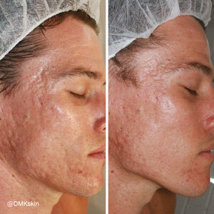 Acne Scaring DMK Treatment - Before and After