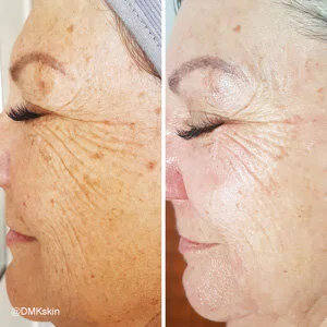 Anti Ageing DMK Treatment - Before and After