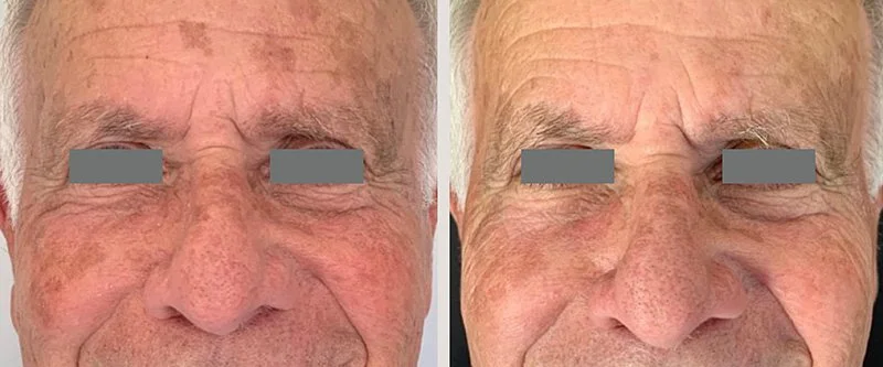 Comparison of two close-up images of an elderly man's face showing skin improvement, with photo on the right having fewer wrinkles and more even skin tone.