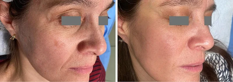 Side-by-side images of a woman showing skin before and after treatment, demonstrating reduced pigmentation and smoother skin.