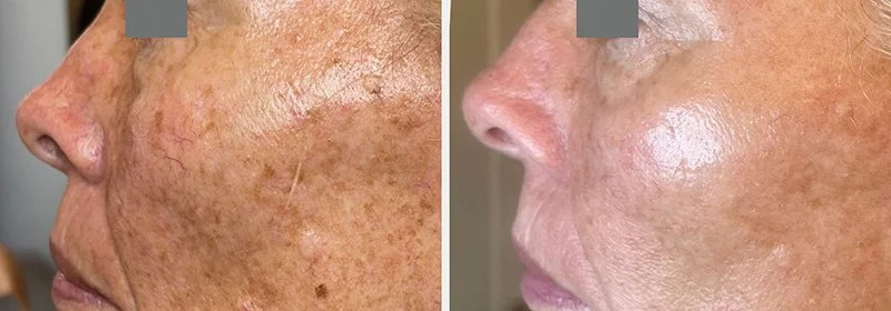 Close-up side-by-side comparison of a person's face showing skin improvement, with visible reduction of pigmentation and spots
