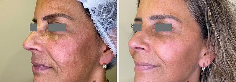 Side-by-side comparison of a woman's face before and after skin treatment, showing improvements in skin texture and tone.