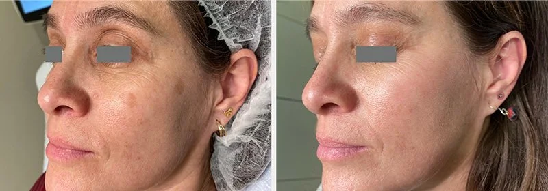 Before and after images of a woman's face showing skin improvements, with the left side showing skin with spots and the right side showing clearer skin.