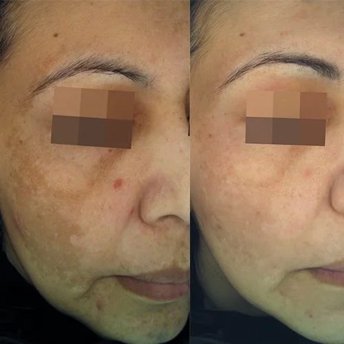 Cosmelan Pigmentation removal treatment before and after results