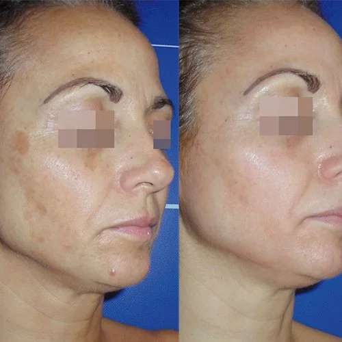 Cosmelan Pigmentation removal treatment Sun damage before and after results