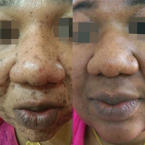 Cosmelan Pigmentation removal treatment hyperpigmentation before and after results