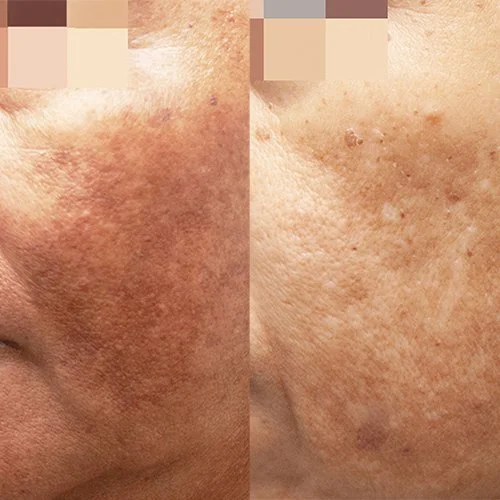 Cosmelan Pigmentation Treatment Before and After Brisbane