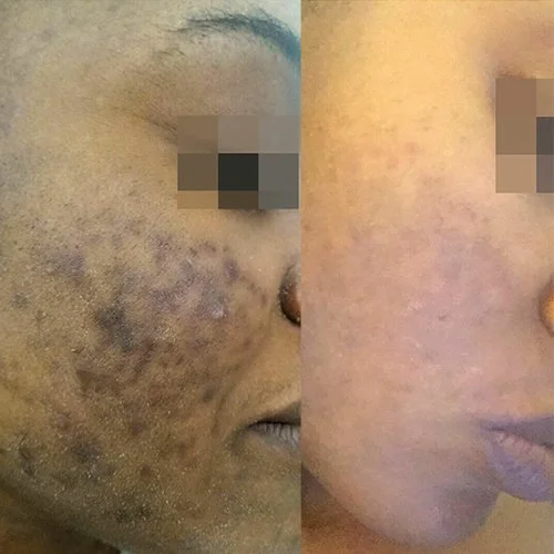 Cosmelan Pigmentation Treatment Before and After Brisbane