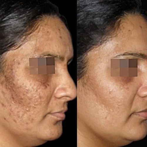 Cosmelan Pigmentation Treatment Before and After Brisbane