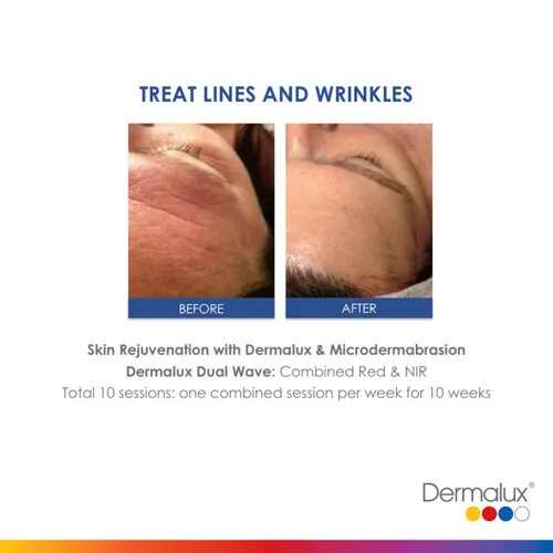 Lines & Wrinkles Treatment - 10 LED Light Therapy Sessions, one session per week for 10 weeks
