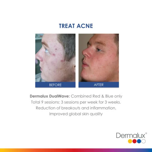 Acne Treatment - 9 LED Light Therapy Sessions, 3 sessions per week for 3 weeks