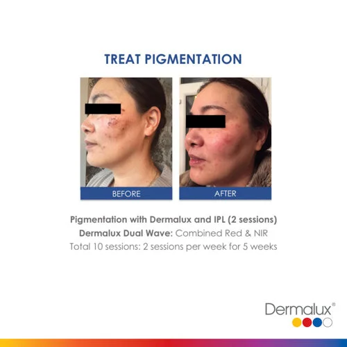 Pigmentation Treatment - 10 LED Light Therapy Sessions, 2 sessions per week for 5 weeks