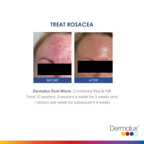 Rosacea Treatment - 10 LED Light Therapy Sessions, 2 per week for 3 weeks and 1 per week for subsequent 4 weeks
