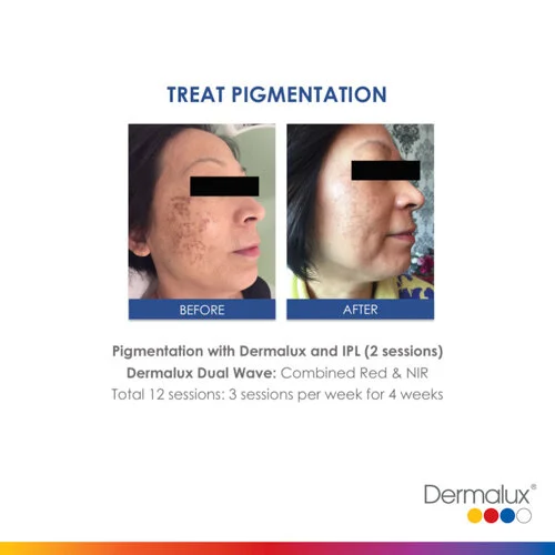 Pigmentation Treatment - 12 LED Light Therapy Sessions, 3 sessions per week for 4 weeks