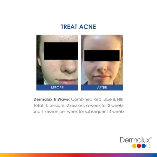 Acne Treatment - 10 LED Light Therapy Sessions, 2 sessions per week for 3 weeks and 1 session per week for subsequent 4 weeks