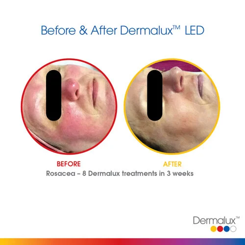 Rosacea Treatment - 8 LED Light Therapy Sessions over 3 weeks