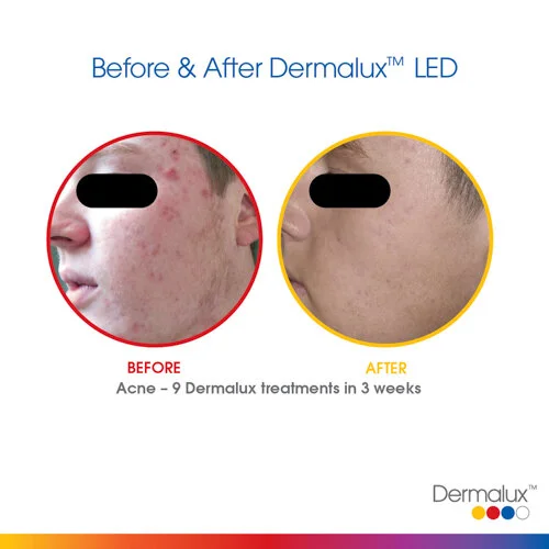 Acne Treatment - 9 LED Light Therapy Sessions over 3 weeks