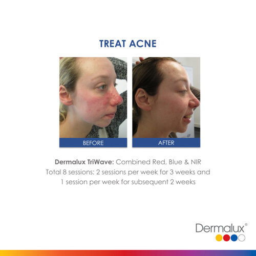 Acne Treatment - 8 LED Light Therapy Sessions, 2 per week for 3 weeks and 1 session per week for subsequent 2 weeks