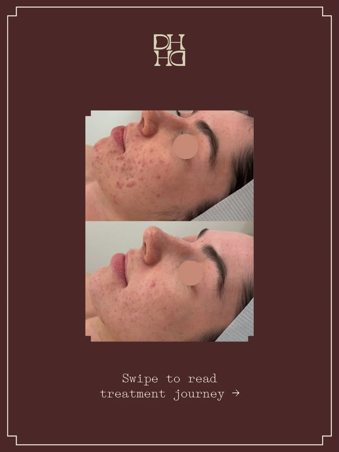 Struggling with acne?

Swipe to read this patient&rsquo;s treatment journey. 

Using @dmkskin @isclinical_anz @brooke_hightechmedical @katehill_dmk