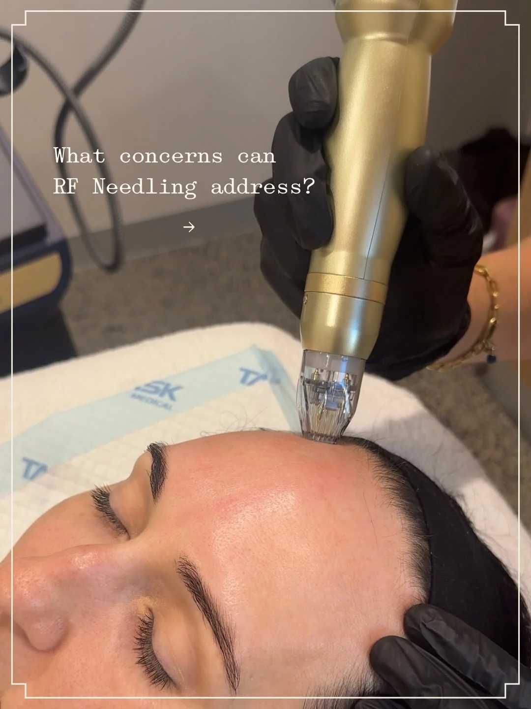 What can RF Needling address? 👇

Using the power of radiofrequency technology delivered into the skin at a dermal level, our RF Needling device helps to address majority of concerns, such as:

- Laxity
- Fine lines and wrinkles
- Under eye laxity
- 