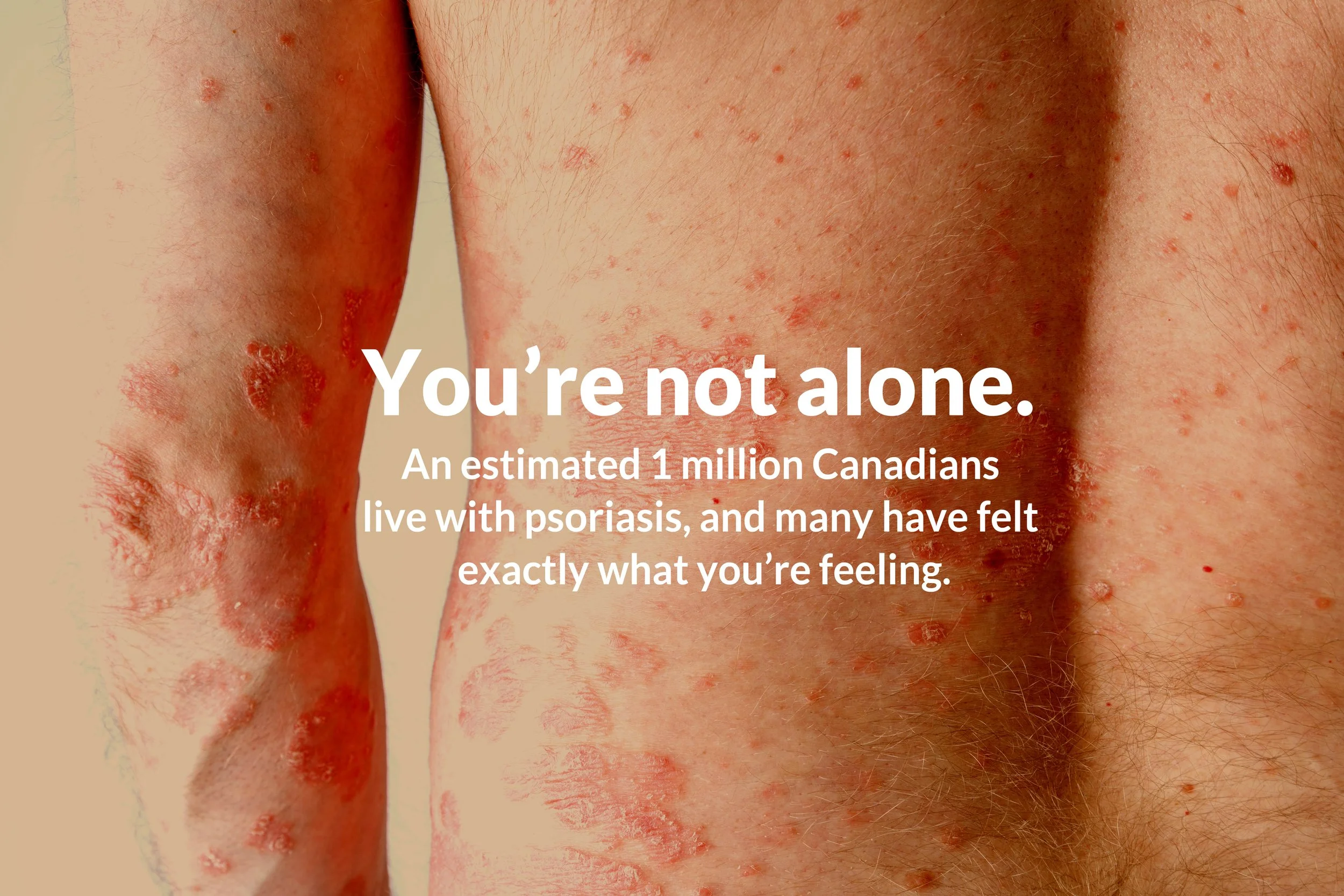 Close-up of skin with redness, bumps, and patches affected by psoriasis.