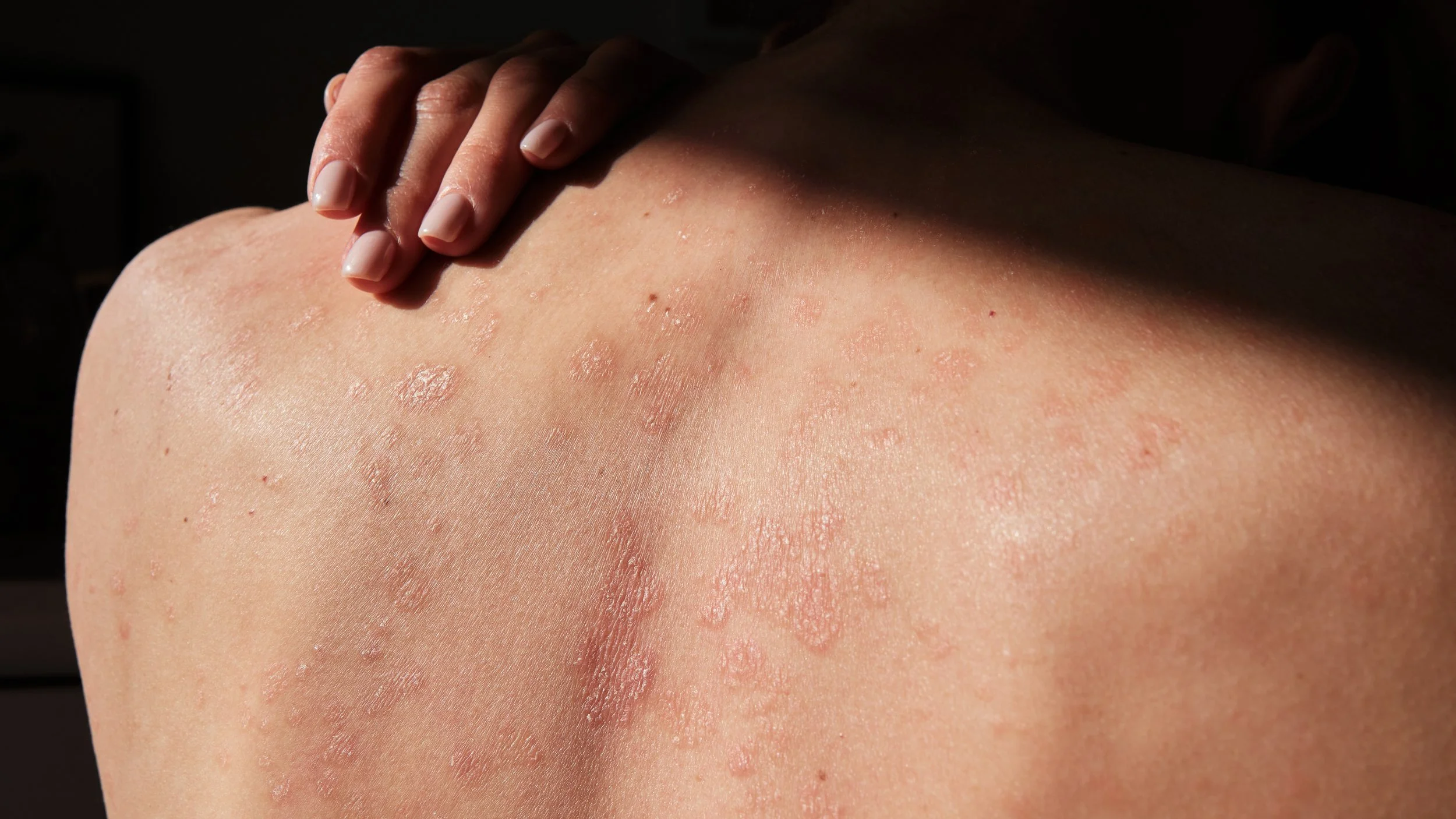 Close-up of a person's shoulder with red, inflamed skin and small bumps, possibly indicating a skin condition or irritation.