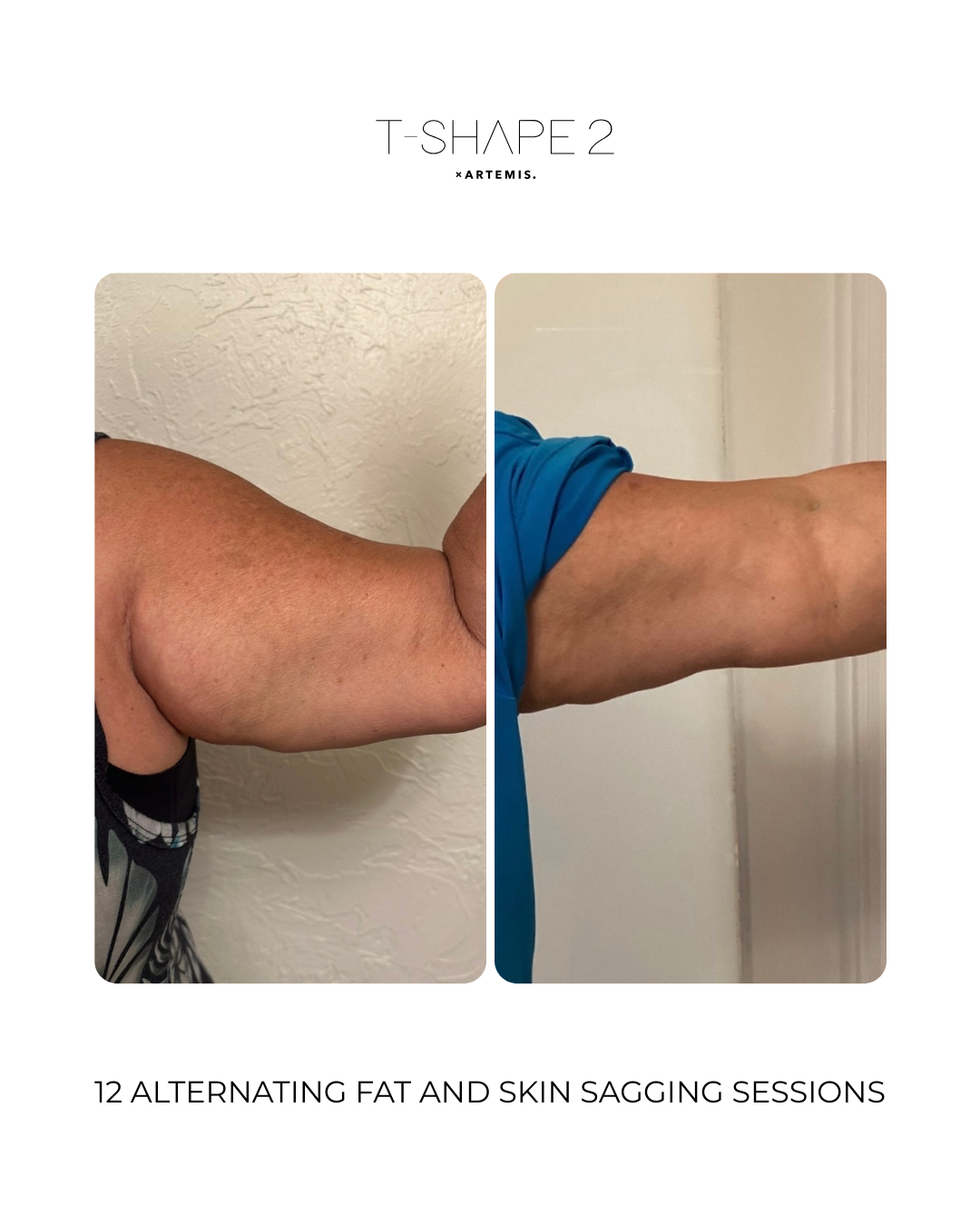 12-sessions-alternating-fat-and-skin-sagging-treatments.png