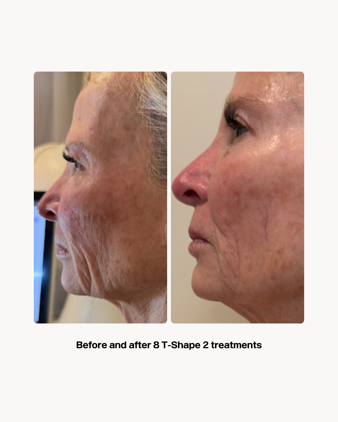 Before and After T-Shape 2 Treatments (1).png