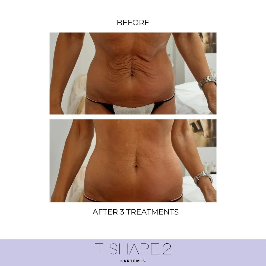 T2_3 treatments_Abdomen.jpg