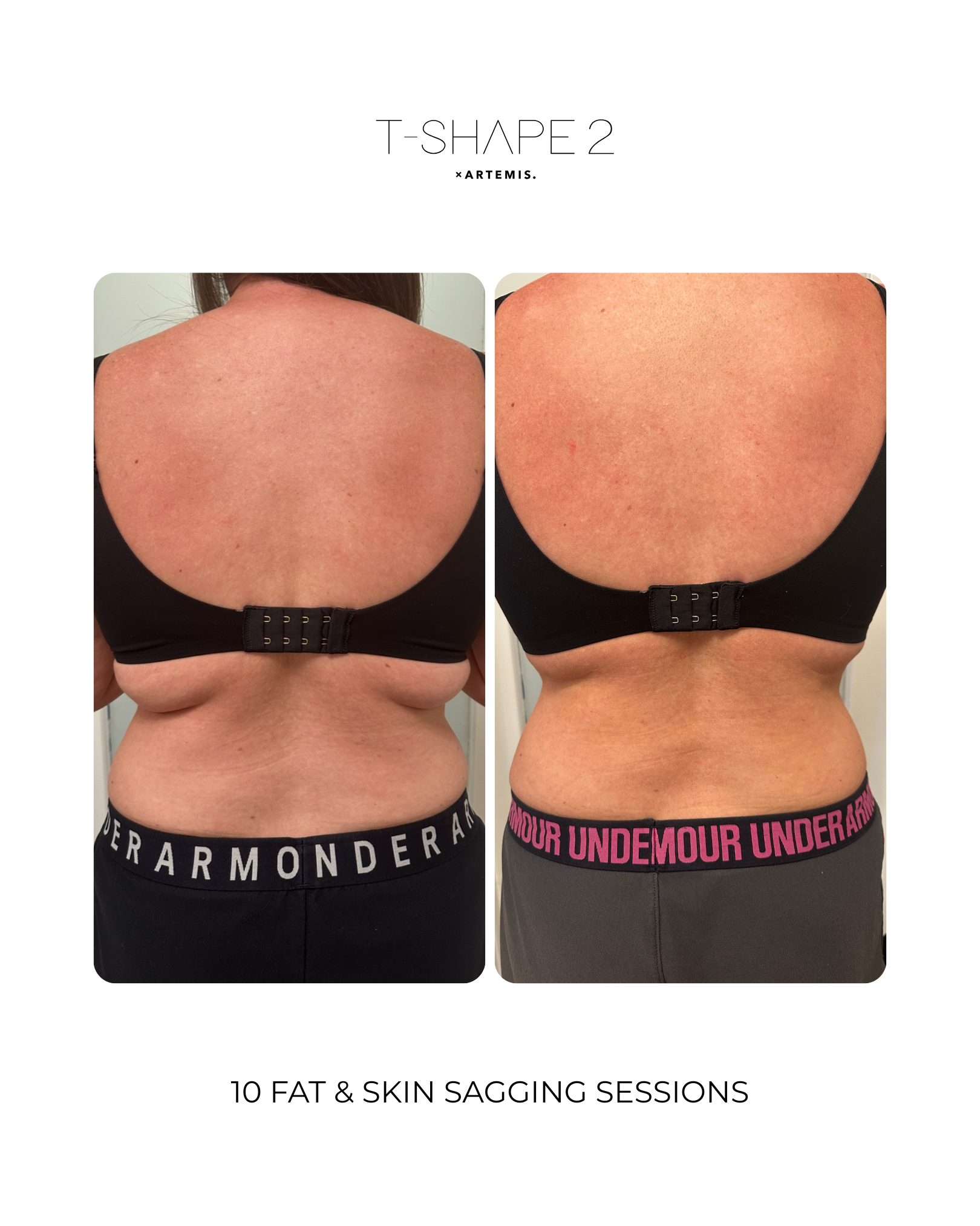 10 Sessions of Fat & Skin Sagging.png