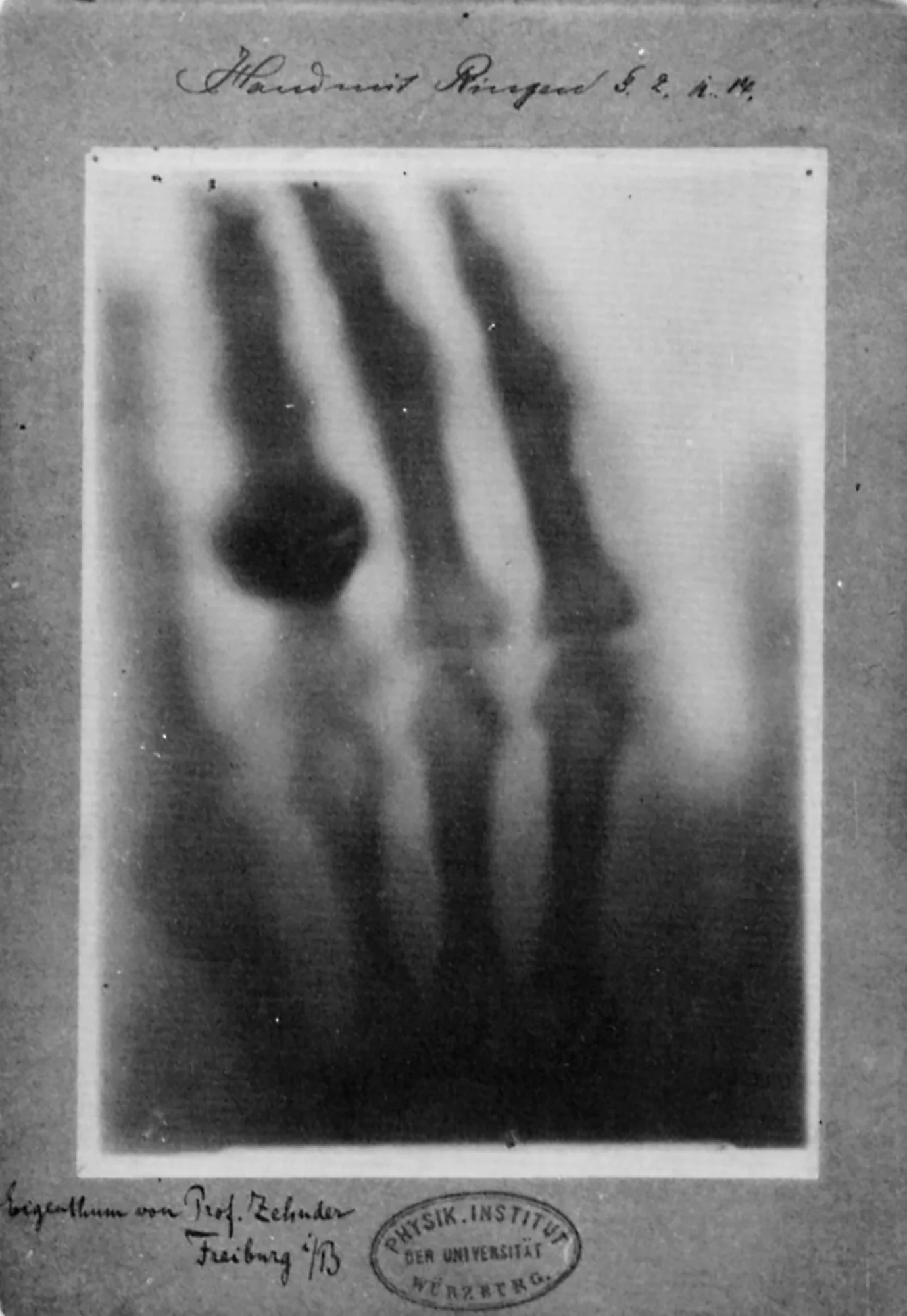 Röntgen 1895: first X-ray photograph — Anna Bertha Ludwig's skeletal hand and wedding ring revealed beneath the flesh.