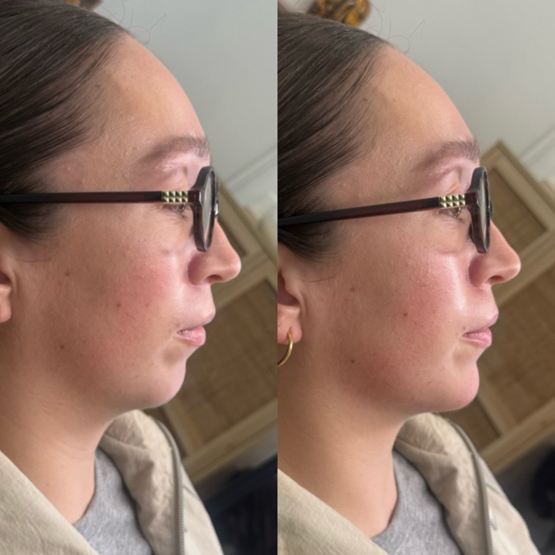 Sometimes all you need is a subtle tweak💉

This beauty came in wanting a more balanced profile and wasn&rsquo;t sure where to start. We had a thorough consultation about her concerns and what she would benefit from, and a subtle chin enhancement is 