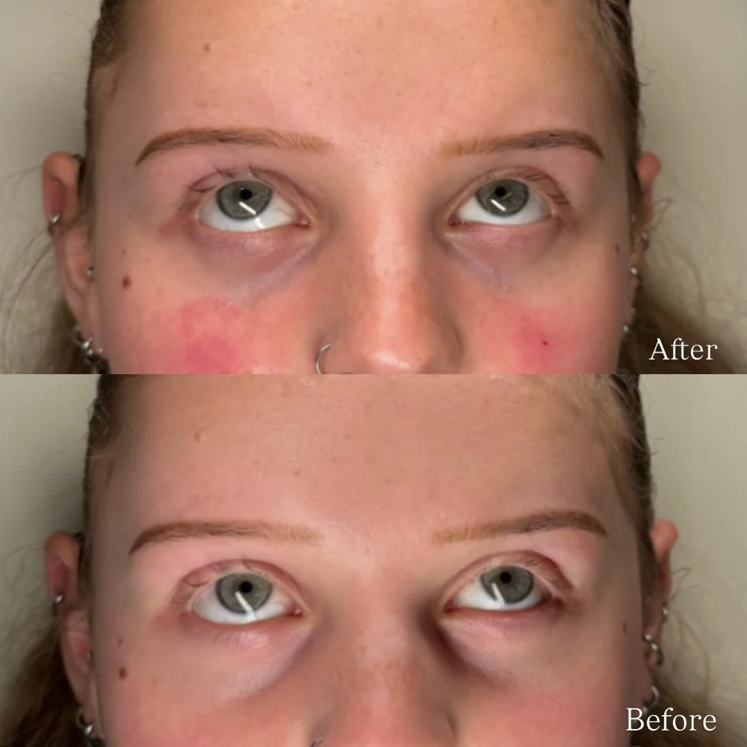 Tear trough filler results💉

Pigmentation vs hollow undereyes👀
Tear trough filler is designed to improve hollowness and shadowing by restoring lost volume under the eyes.Once the structure is corrected and everything has settled, we can then assess