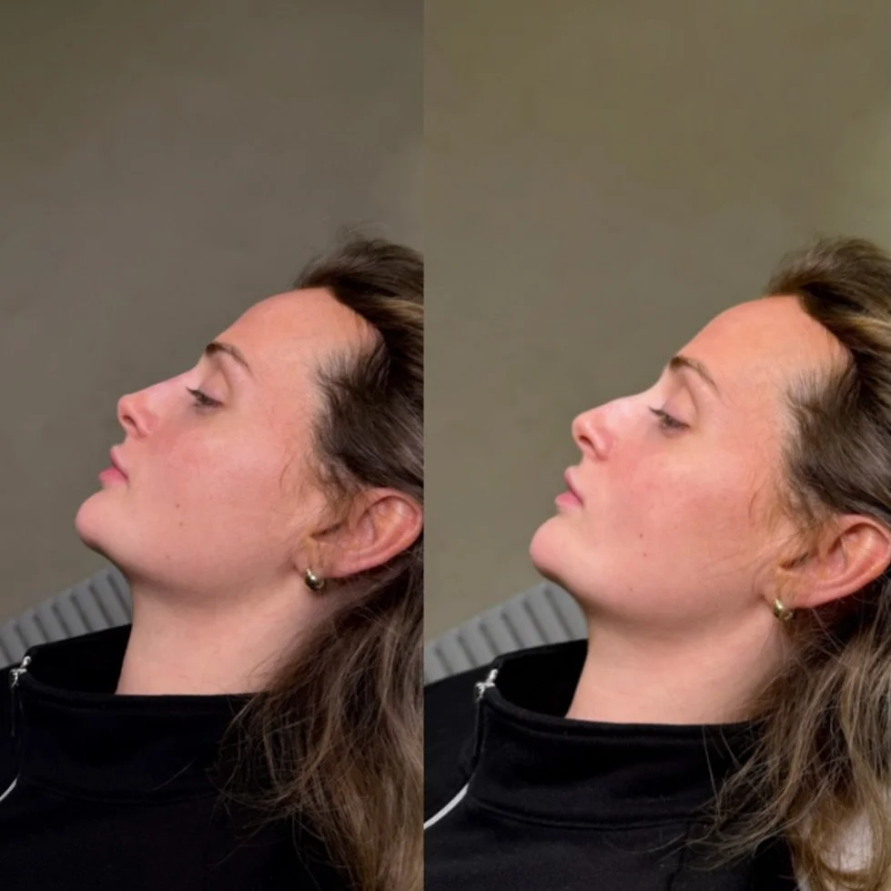 Small tweaks, big difference 💉
Non-liquid rhinoplasty for a smoother, more balanced profile. ✨

Use code: EASTERSUNDAY for 10% off all treatments✨🫶🏻

#nonsurgicalnosejob #liquidrhinoplasty #nurseinjectors #cardiffbeauty #pembrokeshire