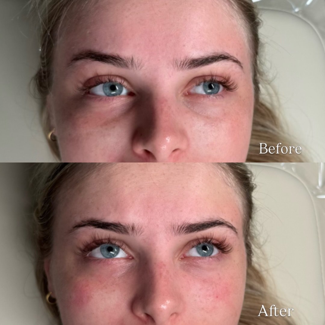 Tear Trough Filler: Myths vs Facts 👀✨

Myth: Tear trough filler always looks puffy.
Fact: When placed correctly, results should be subtle and natural.

Myth: Tear trough filler is for everyone.
Fact: Not every under-eye concern is caused by volume l