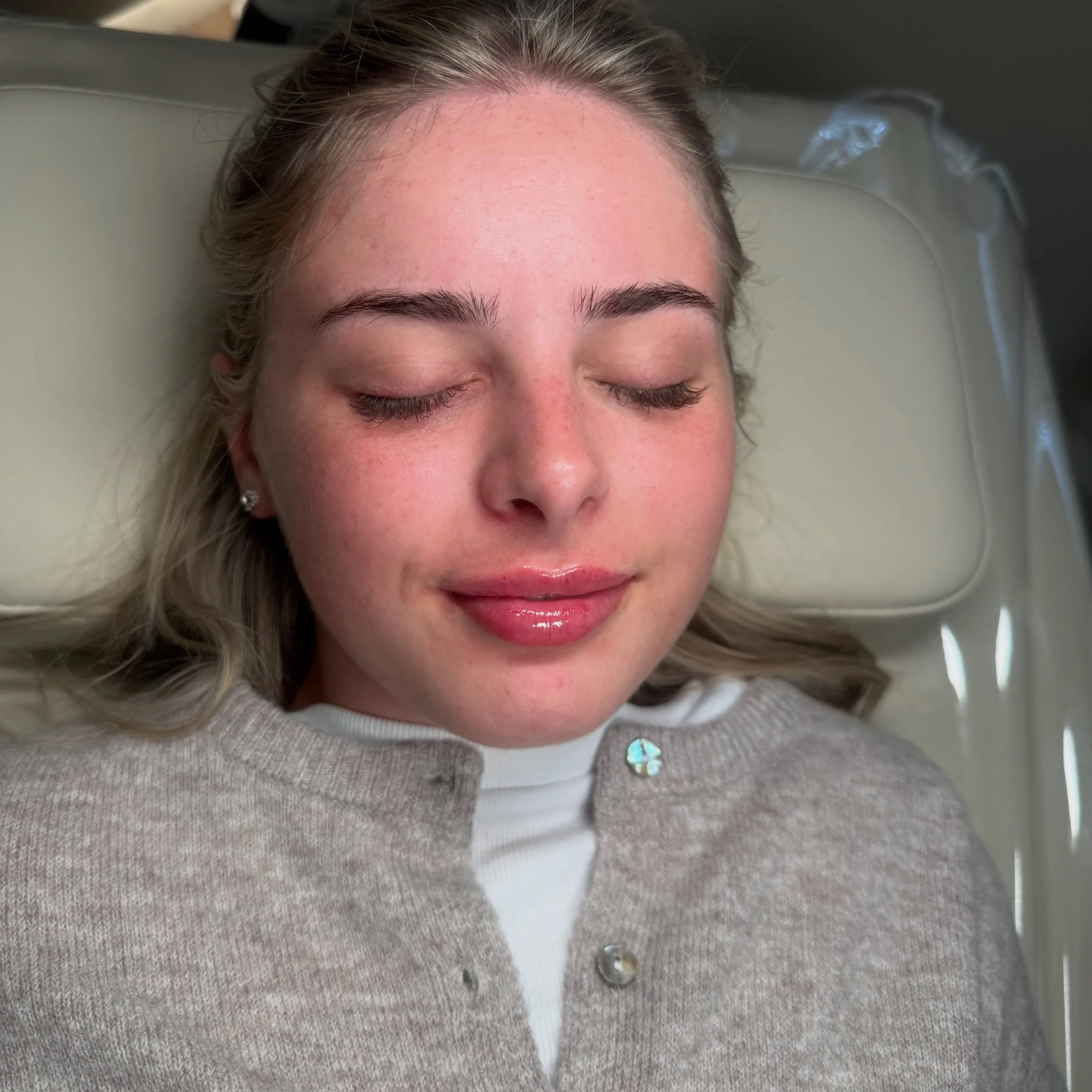 Built up over 2 sessions👄

One of the biggest misconceptions about lip filler is that &ldquo;more filler = better lips.&rdquo; In reality, the most balanced, long-lasting and natural-looking results often come from building the lips gradually over m