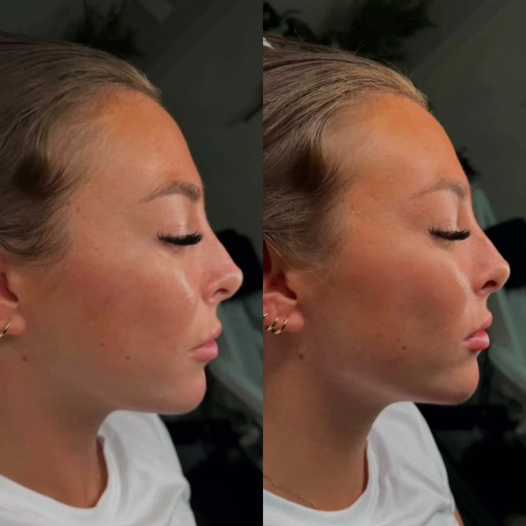 Subtle Chin, pre jowl and jaw enhancement💉

Can you guess how much filler was used???