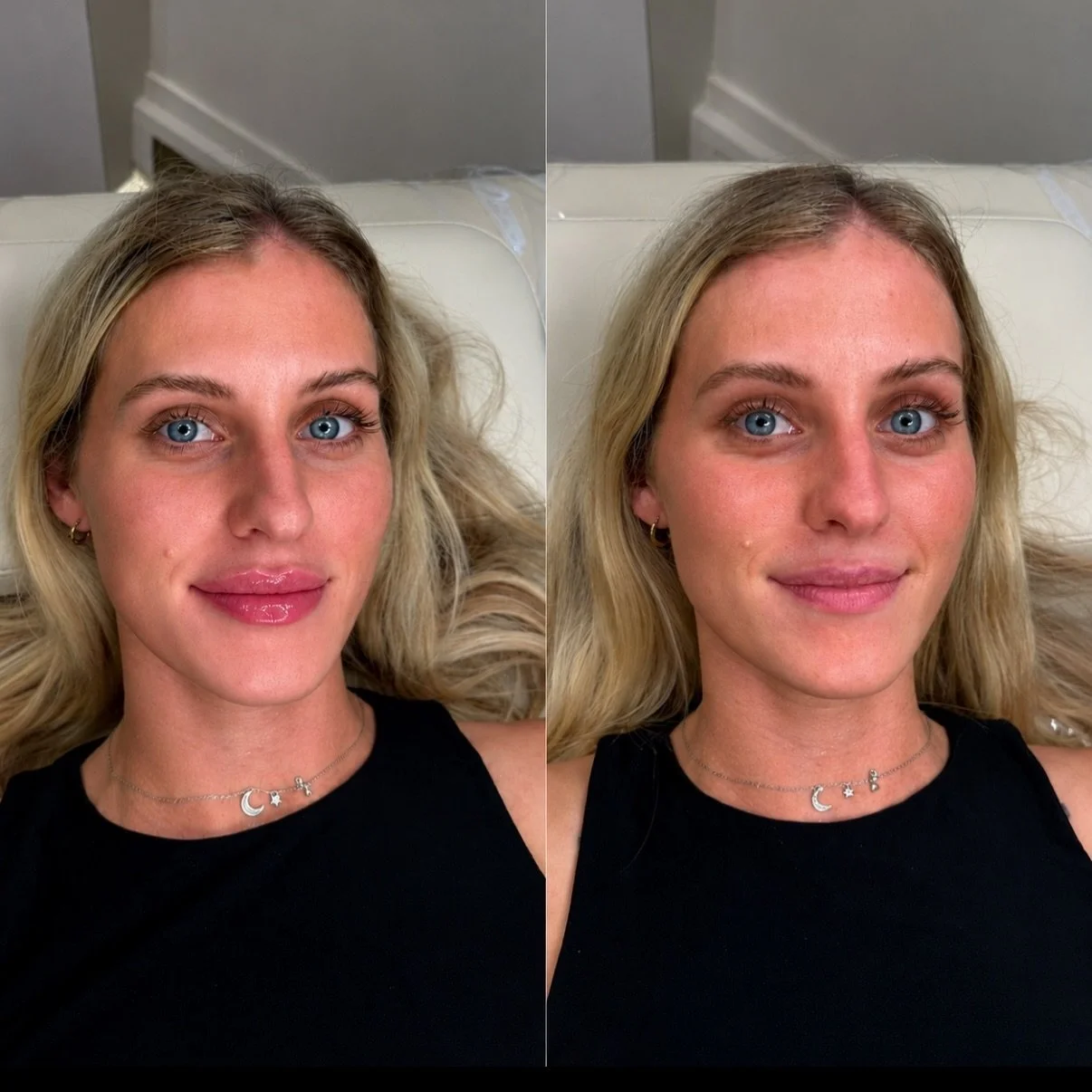 0.5ml lip top-up 💉✨

A little swelling is completely normal here &mdash; especially as it was a warm day and my client had recently consumed caffeine before her appointment. ☕️☀️

Why can this increase swelling?
💧 Heat causes blood vessels to dilat