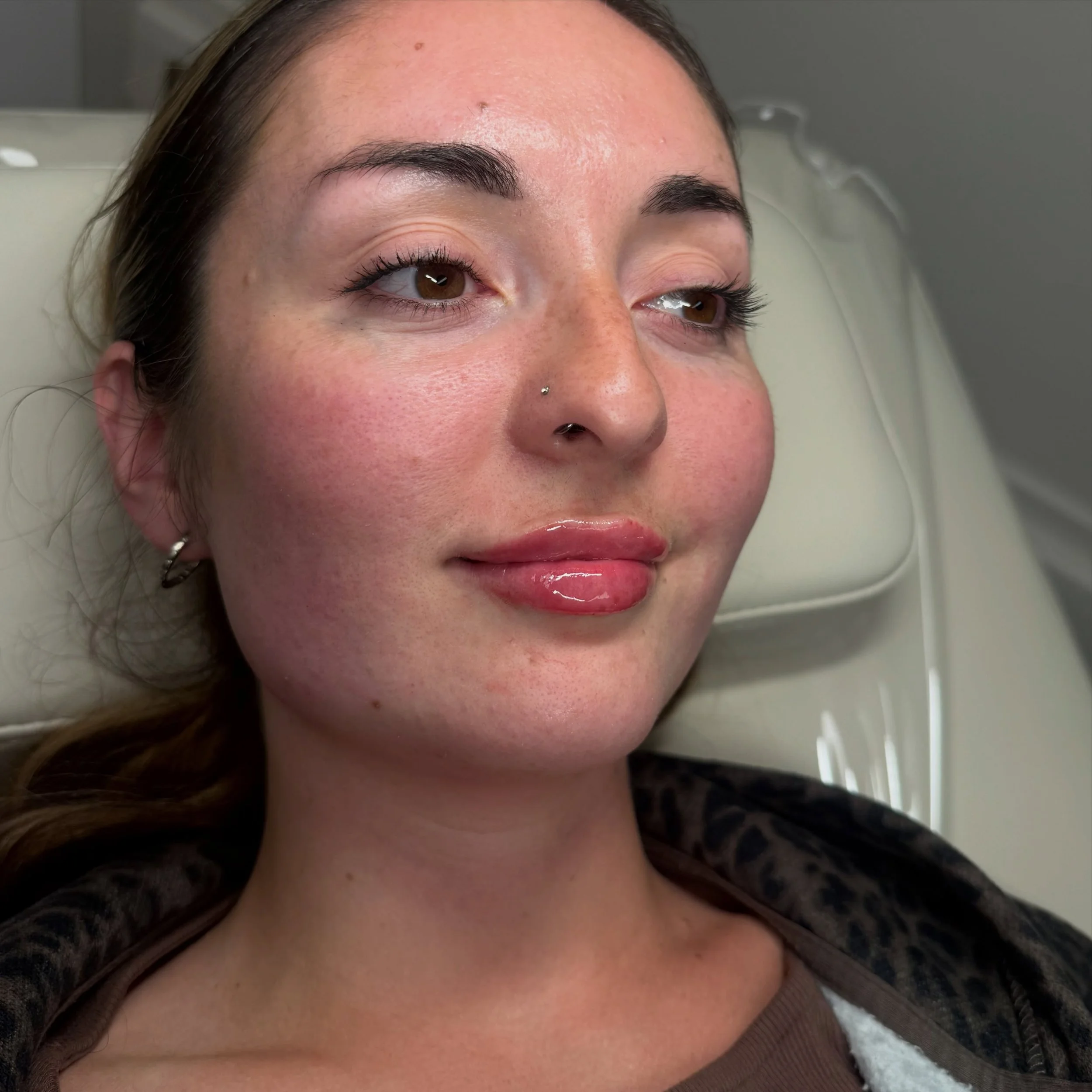 A 0.5ml annual top up for gorgeous Georgia ✨💉

#lipfillersuk #aesthetics #facialbalancing
