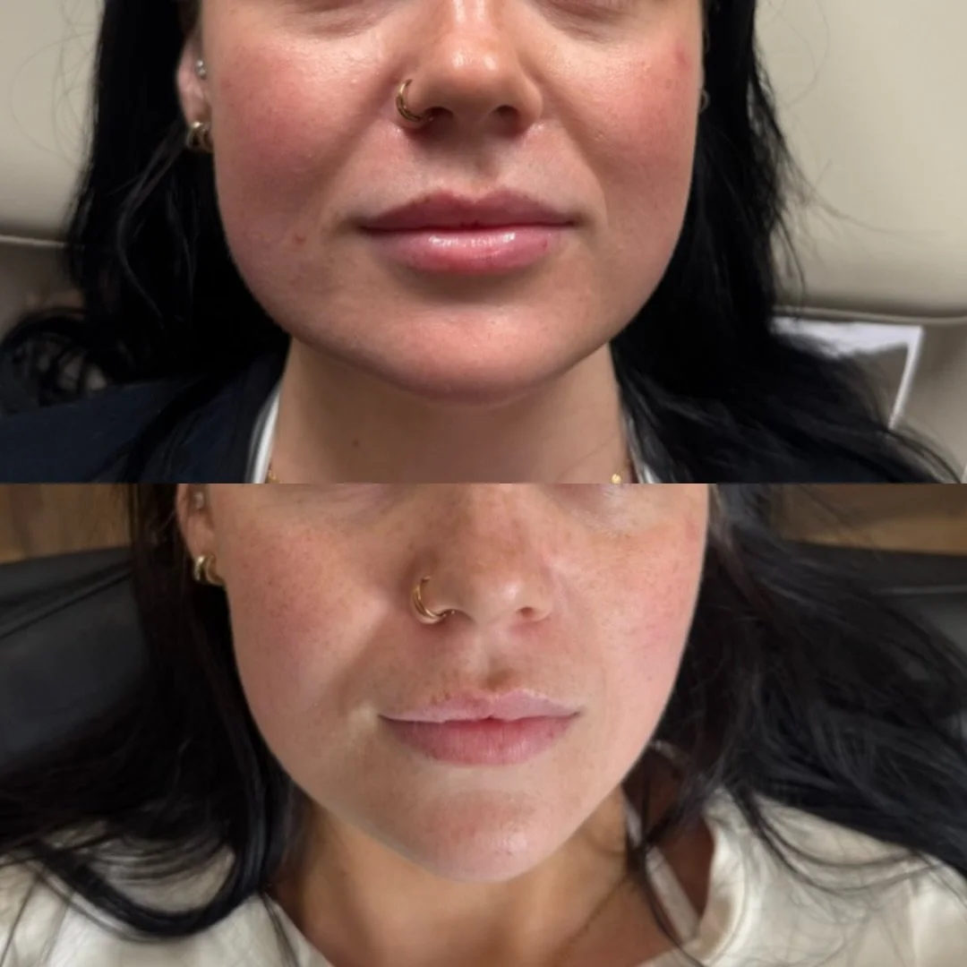 The Results✨💉

2 weeks after initial master anti wrinkle appointment- 2 week complimentary review included in all anti wrinkle treatments✨

Masseter Anti Wrinkle Treatment:
&bull; Relaxes overactive masseter muscles
&bull; Softens the appearance of 