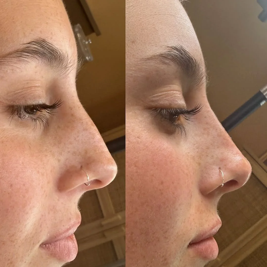 Refined facial contours following dermal filler treatment