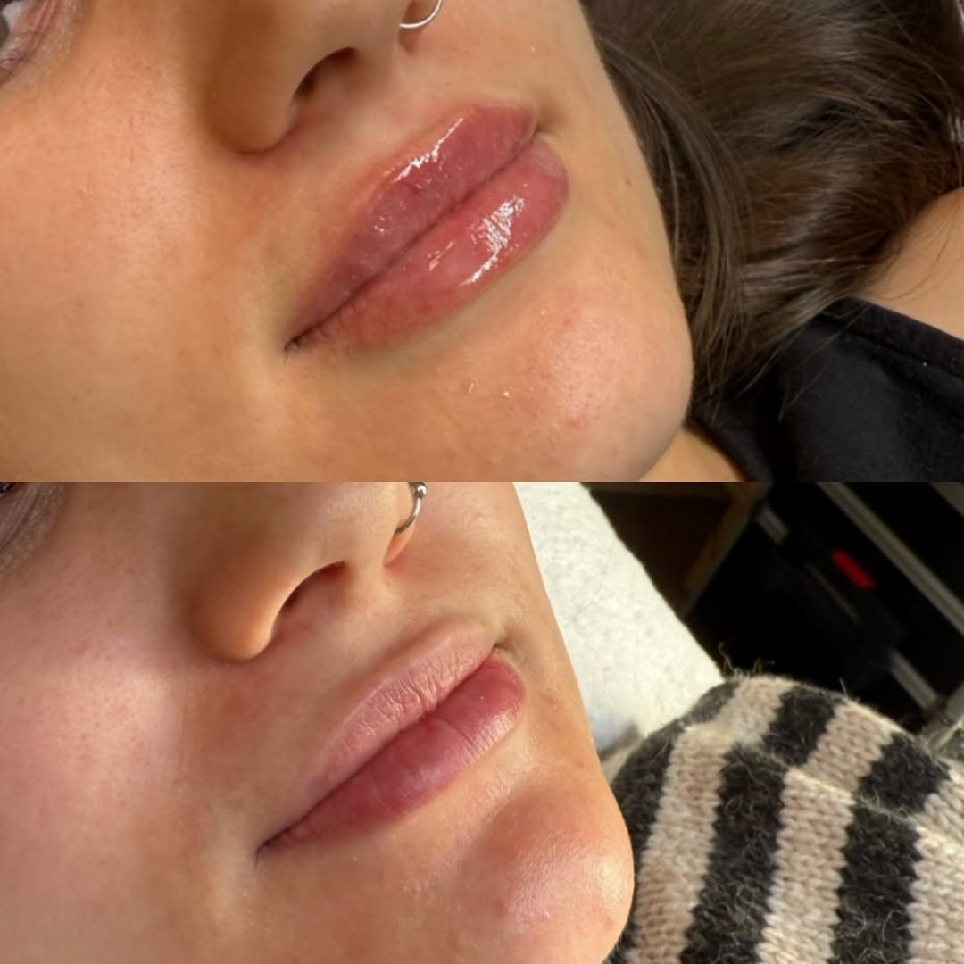 Natural lip filler enhancement with soft, balanced volume